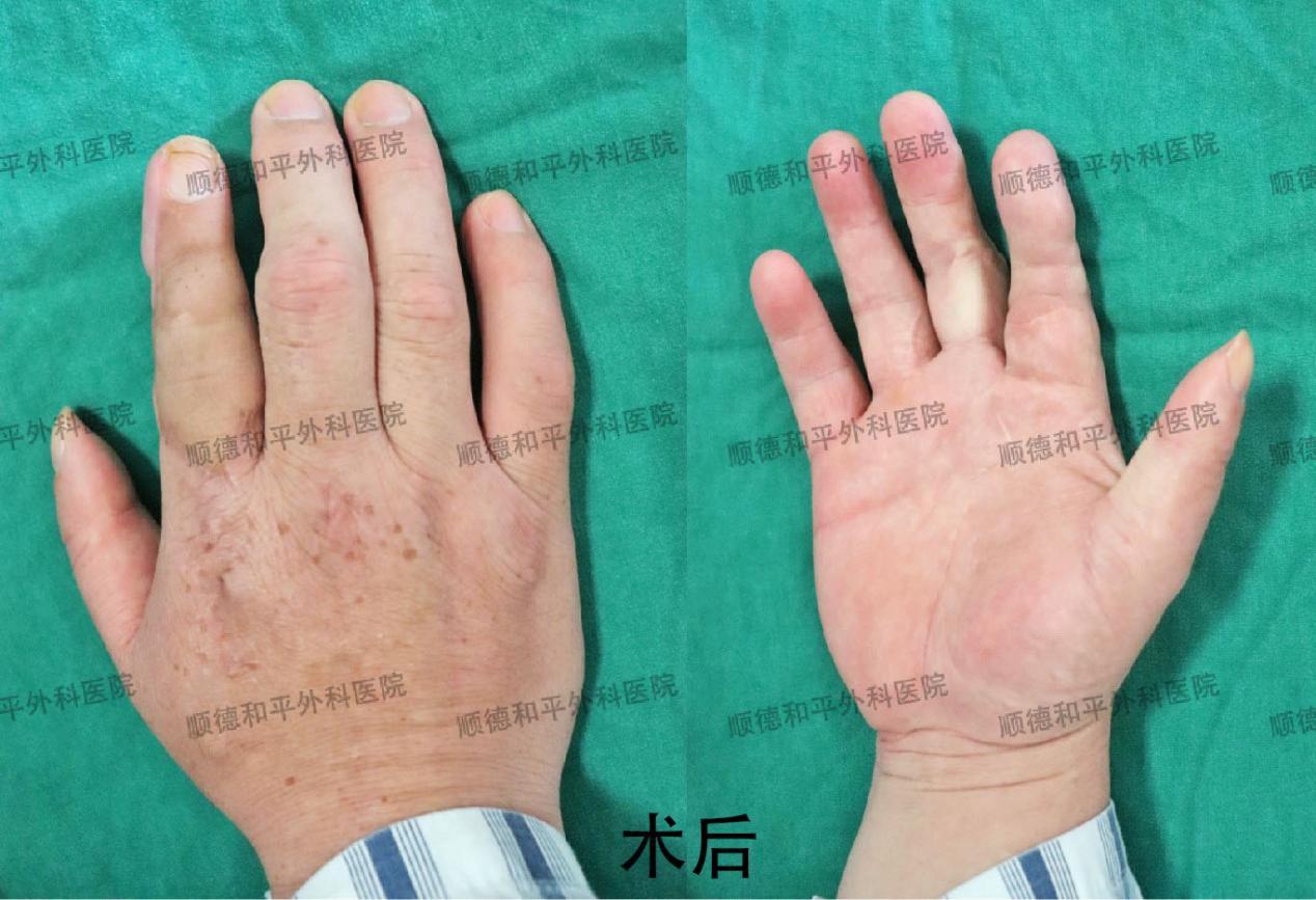 新疆患者失去手指心生自卑，遠赴廣東手指再造＿手外科醫院咨詢(圖2)