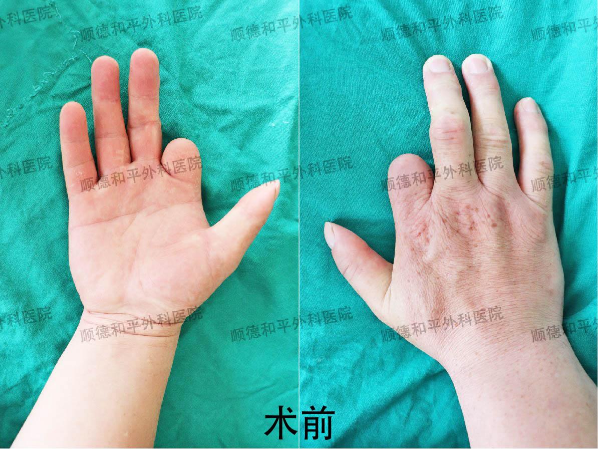 新疆患者失去手指心生自卑，遠赴廣東手指再造＿手外科醫院咨詢(圖1)