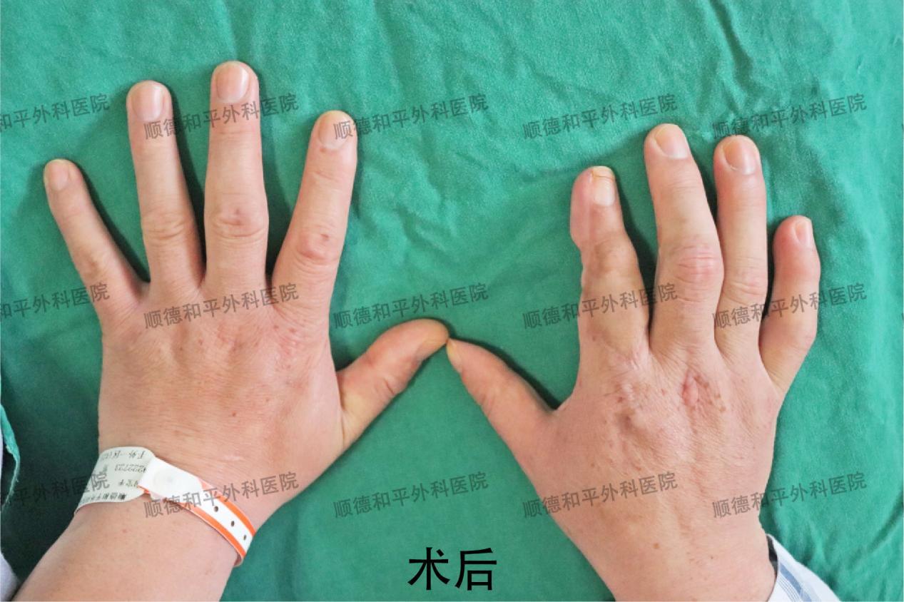 新疆患者失去手指心生自卑，遠赴廣東手指再造＿手外科醫院咨詢(圖3)