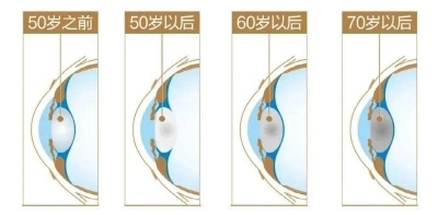 愛爾眼科：白內(nèi)障不會“缺席”只會“遲到”？(圖6)