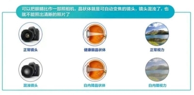 愛爾眼科：白內(nèi)障不會“缺席”只會“遲到”？(圖1)