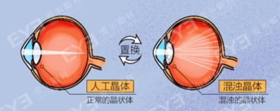 愛爾眼科：白內(nèi)障不會“缺席”只會“遲到”？(圖4)